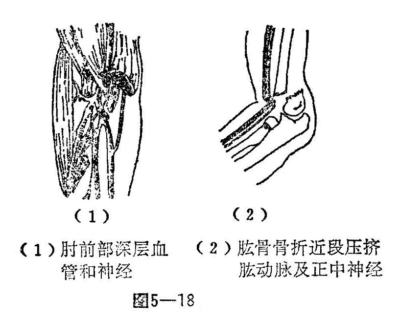 四 肱骨髁上骨折 光明中医教材