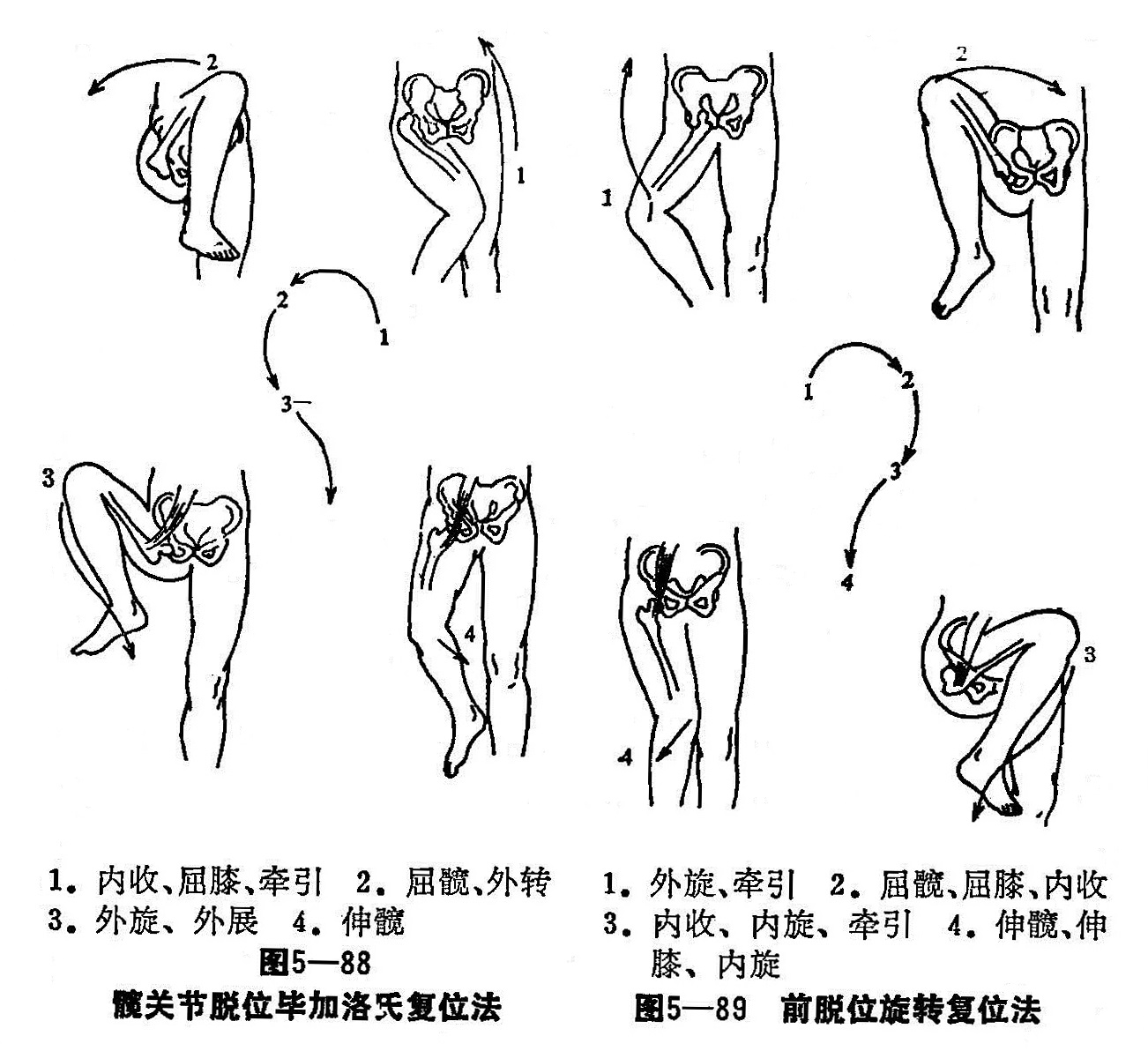 右髋臼假体破裂松动伴髋臼骨缺损图片_自贡市第一人民医院